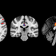 Illustration for article titled Brain Scans Show Signs Of Cognitive Decline Before Symptoms Appear